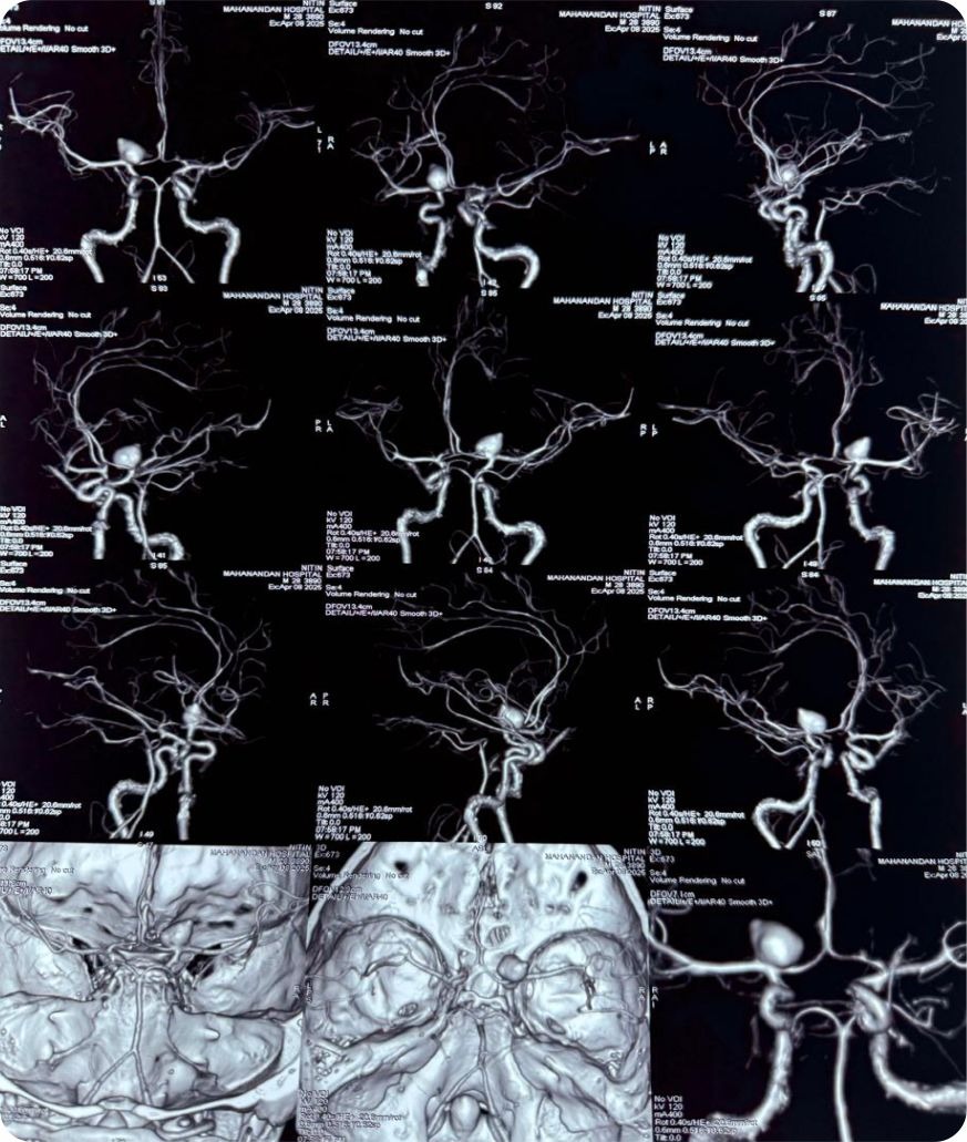Successful Clipping of Giant Internal Carotid Artery Aneurysm at Mahanandan Super Speciality Hospital